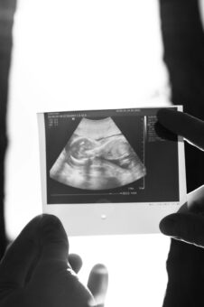 Blog 3 antenatal scans